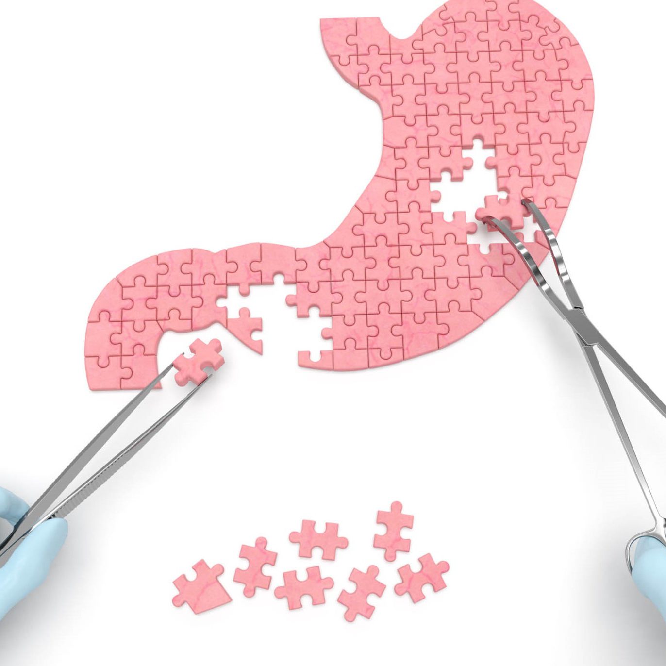 reduccion de estomago en Valencia - puzzle