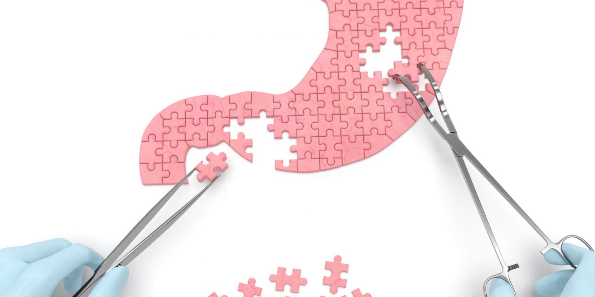 reduccion de estomago en Valencia – puzzle reduccion de estomago en Valencia - puzzle