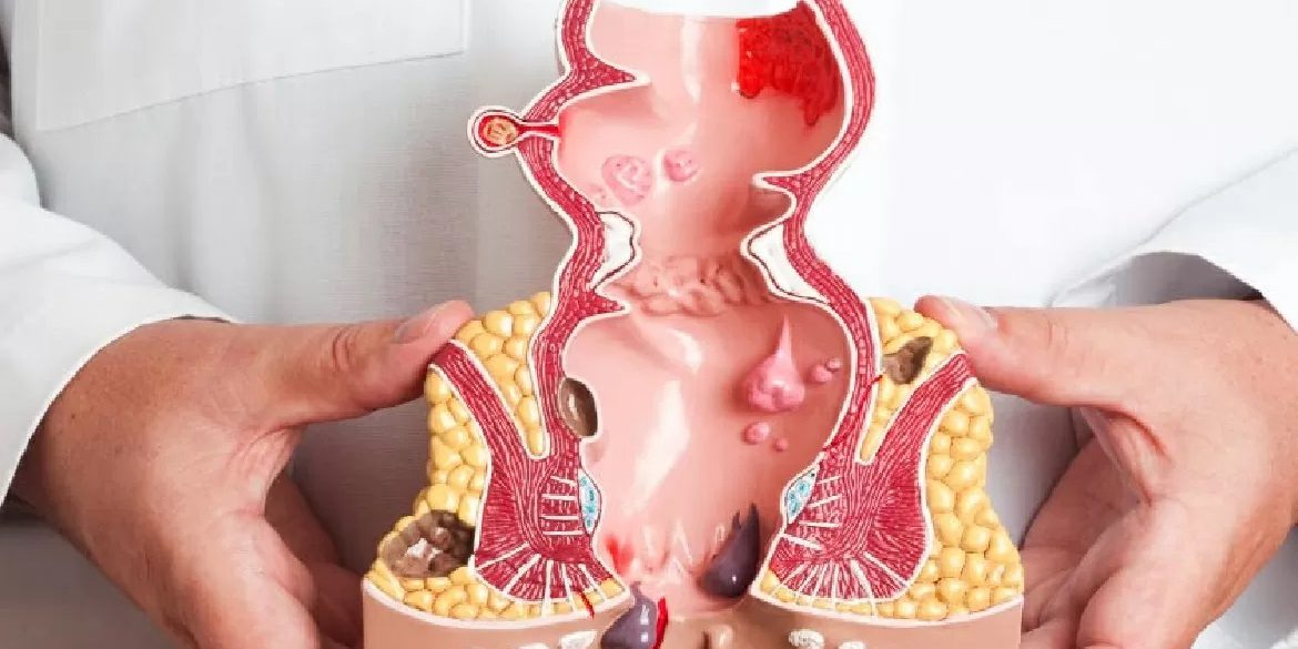 Especialistas en enfermedades de recto en Valencia – modelo Especialistas en enfermedades de recto en Valencia - modelo