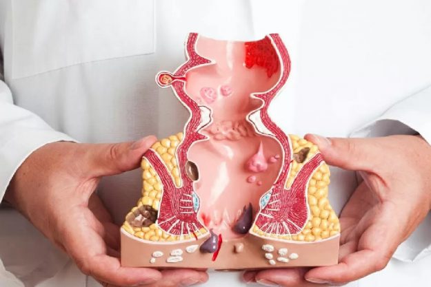 Especialistas en enfermedades de recto en Valencia - modelo